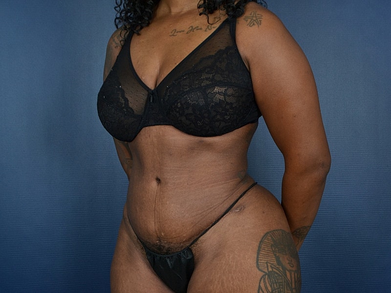 Liposuction Before & After