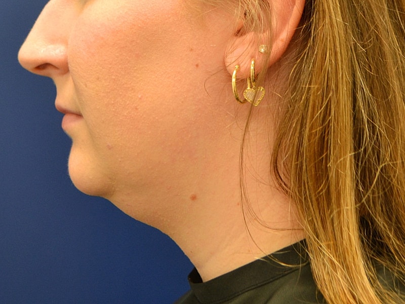 Liposuction Before & After