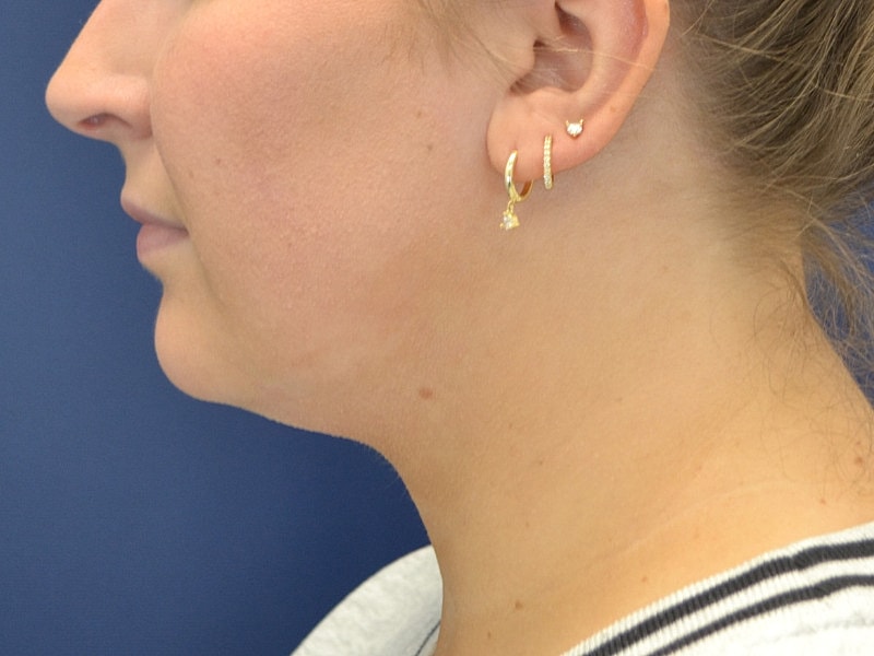 Liposuction Before & After