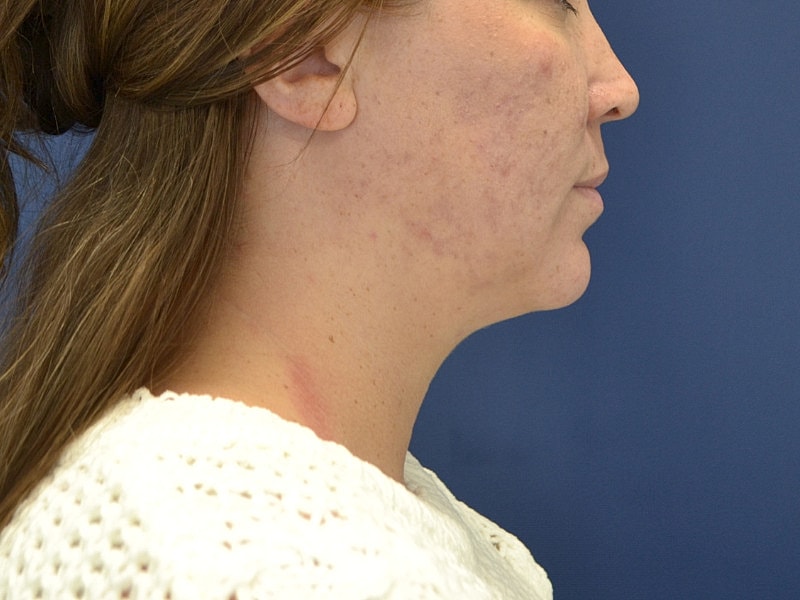 Liposuction Before & After