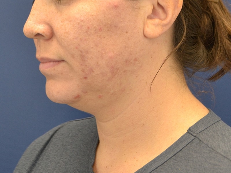 Liposuction Before & After