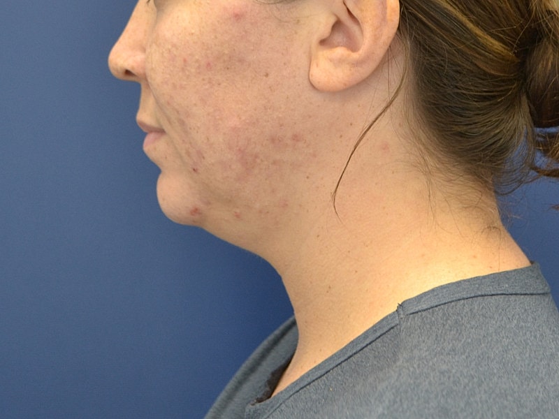 Liposuction Before & After
