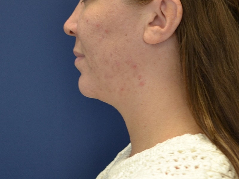 Liposuction Before & After