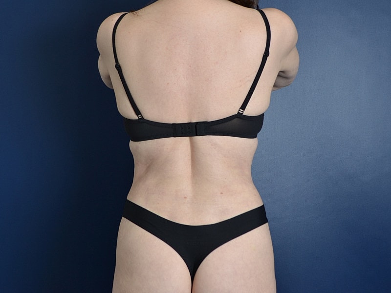 Liposuction Before & After