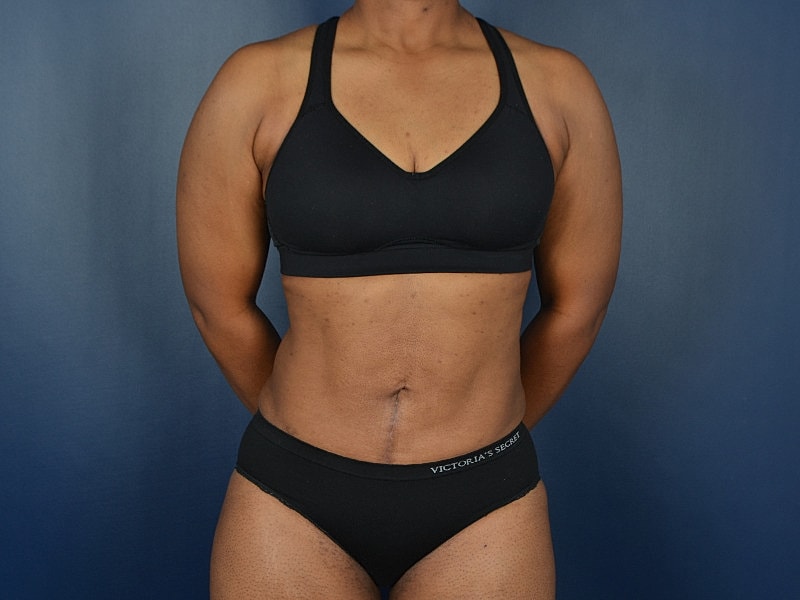Liposuction Before & After
