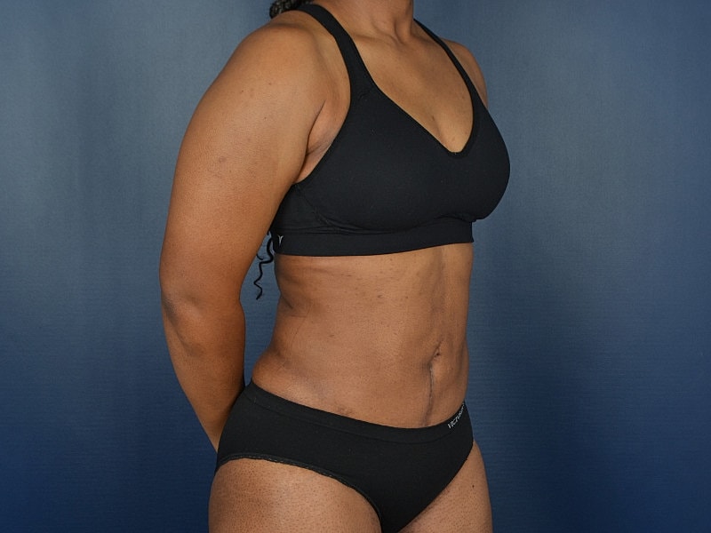 Liposuction Before & After