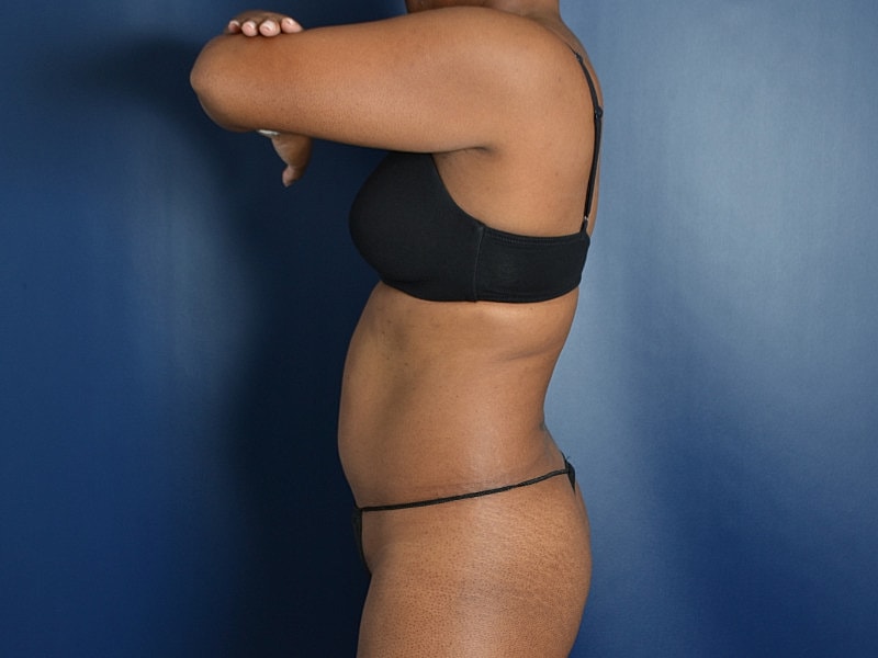 Liposuction Before & After