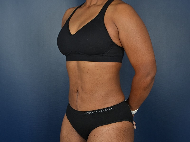 Liposuction Before & After