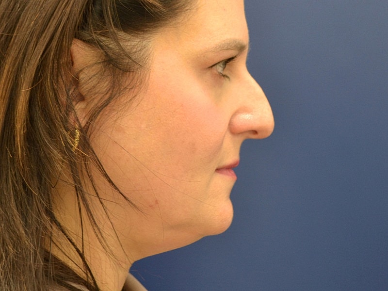 Liposuction Before & After