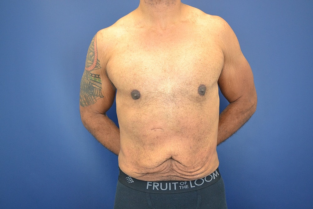 Liposuction Before & After
