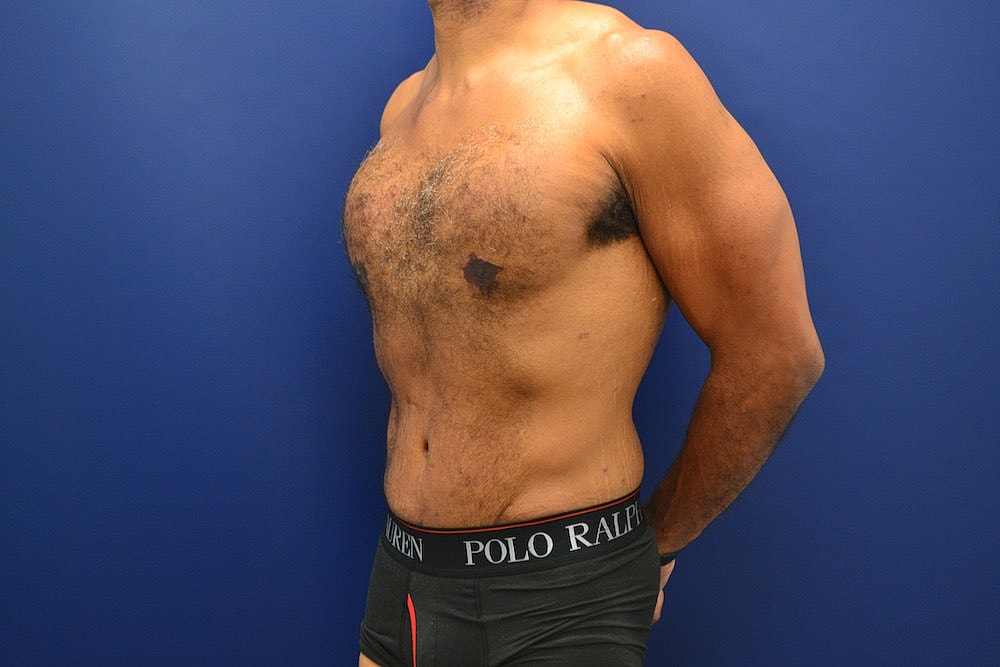 Liposuction Before & After