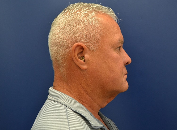 Male Neck Lift Before & After
