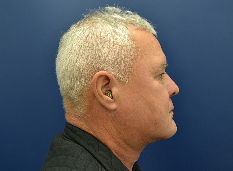 Male Neck Lift Before & After