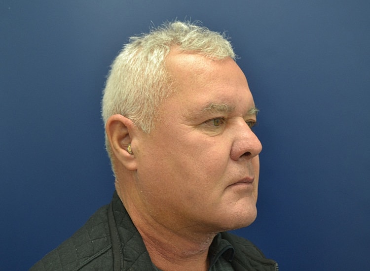 Male Neck Lift Before & After