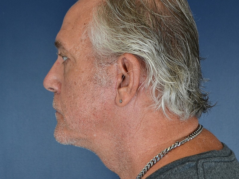 Male Neck Lift Before & After