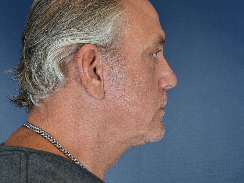 Male Neck Lift Before & After