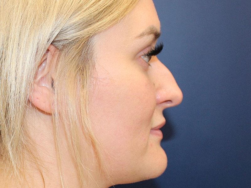 Rhinoplasty Before & After
