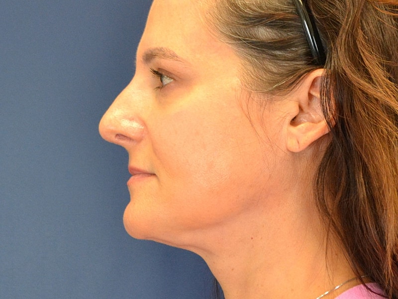 Rhinoplasty Before & After