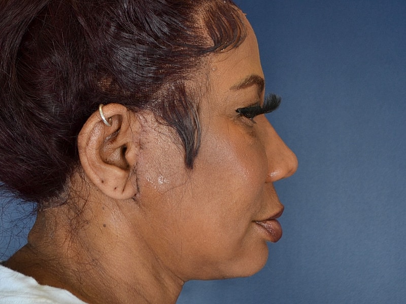 Rhinoplasty Before & After
