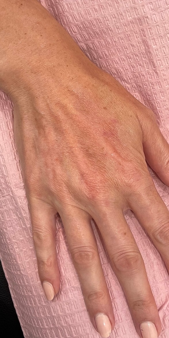 Hand Fillers Before & After