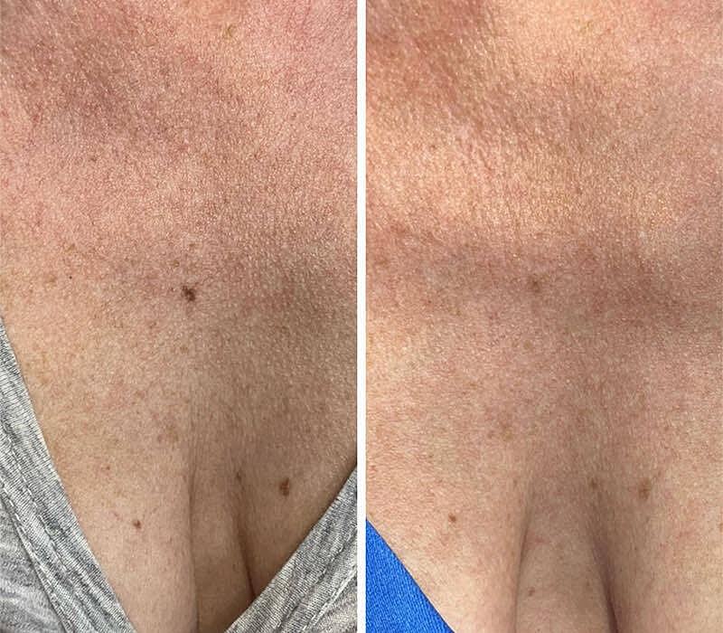 Ipl Before & After