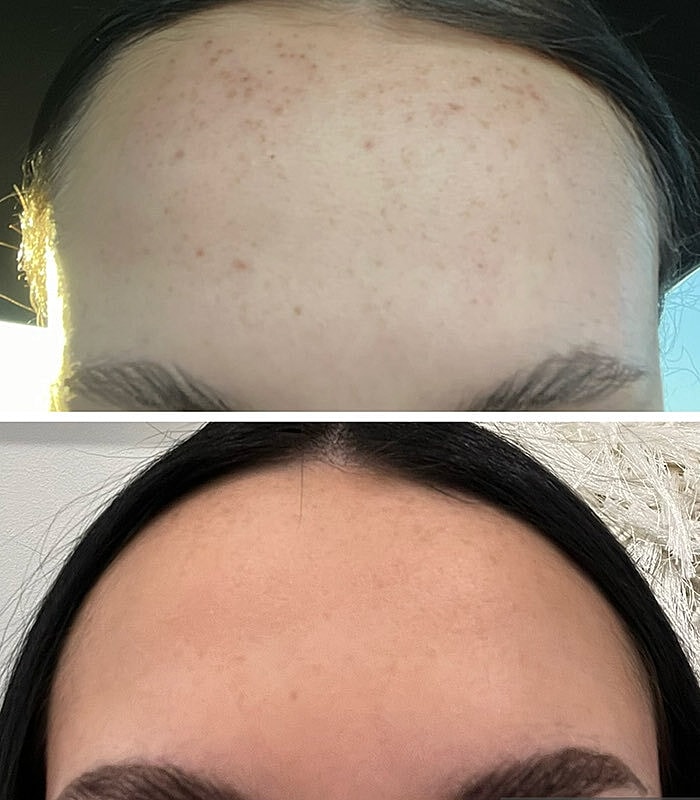 Ipl Before & After