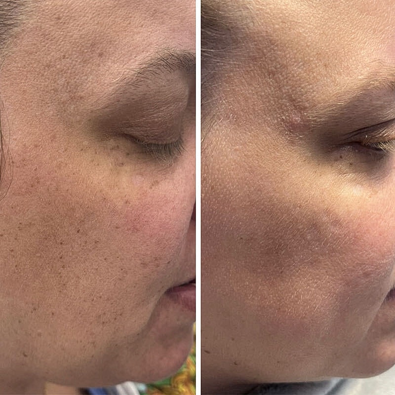 Ipl Before & After