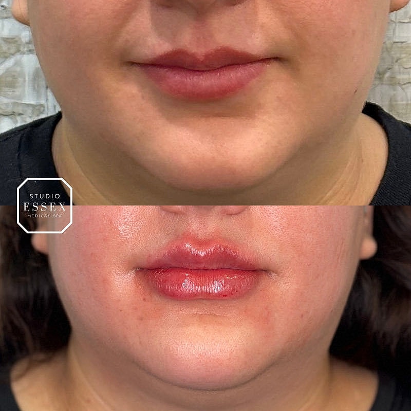 Lip Filler Before & After