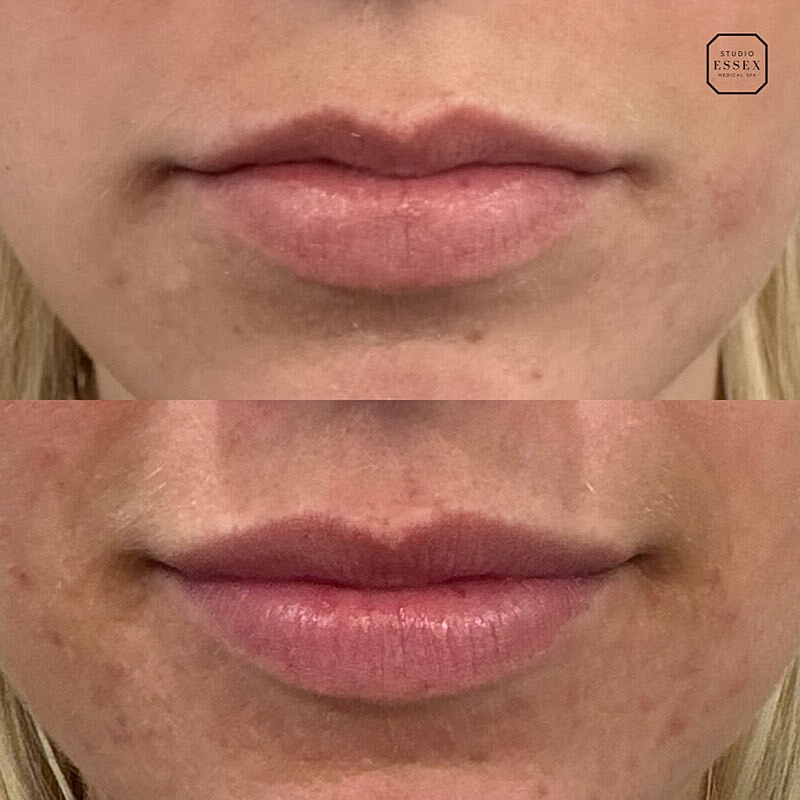 Lip Filler Before & After