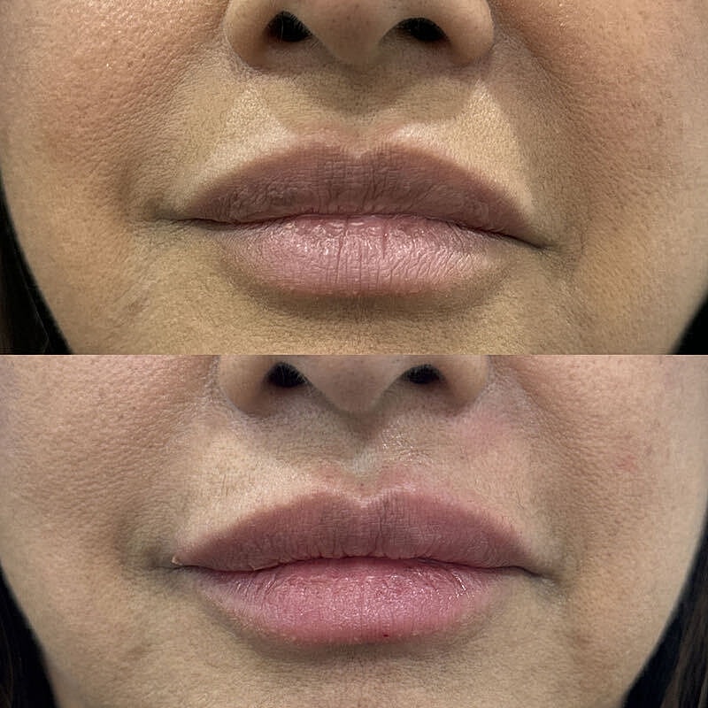 Lip Filler Before & After