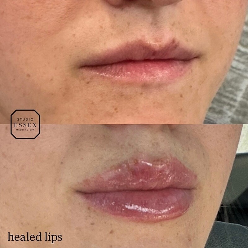 Lip Filler Before & After