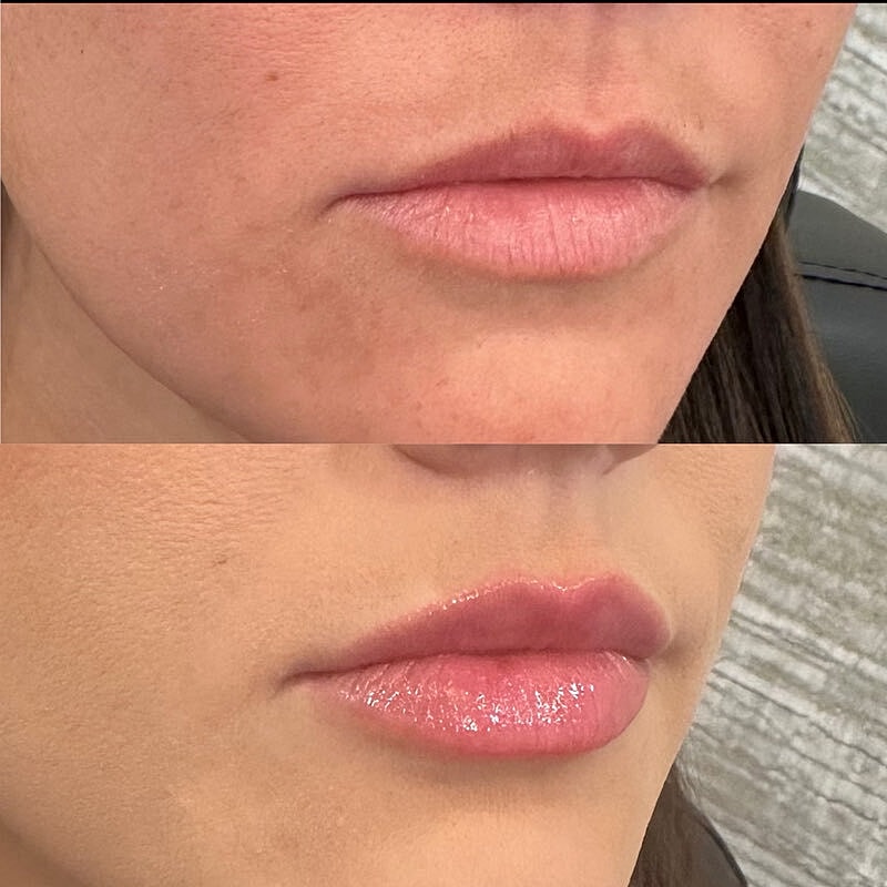 Lip Filler Before & After