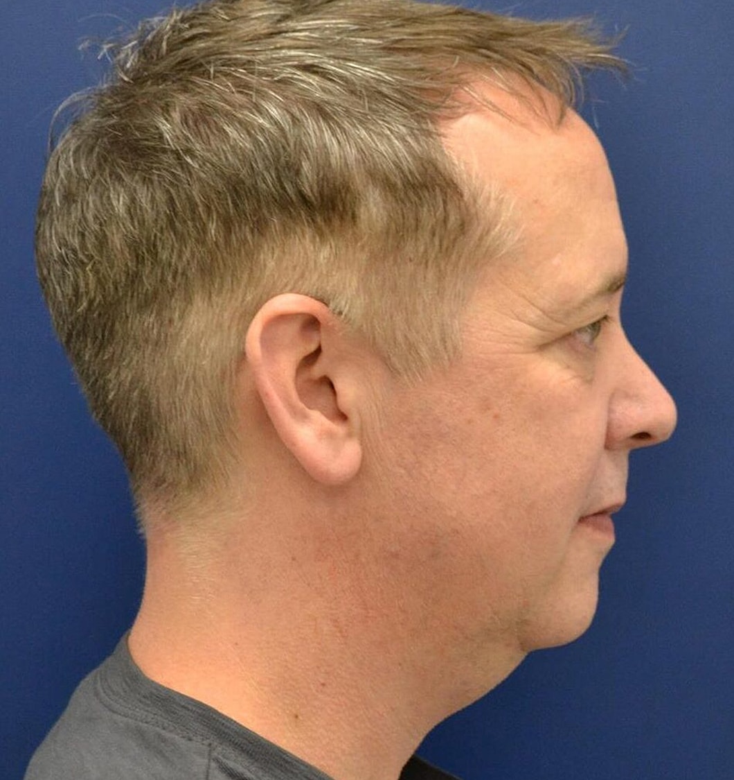 Chin Implants Before & After