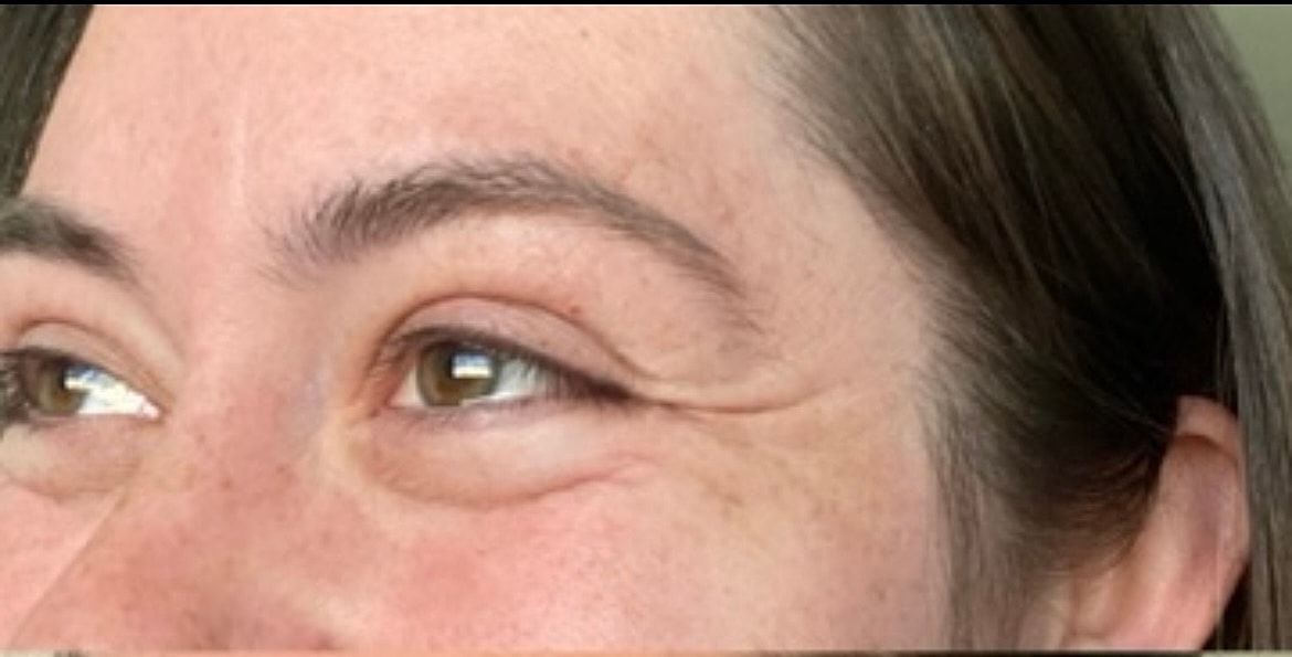 Toxin Treatments Before & After