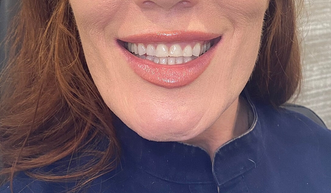 Toxin Treatments Before & After