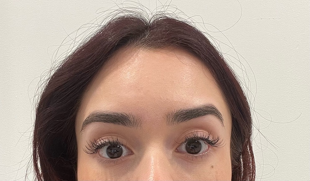 Toxin Treatments Before & After