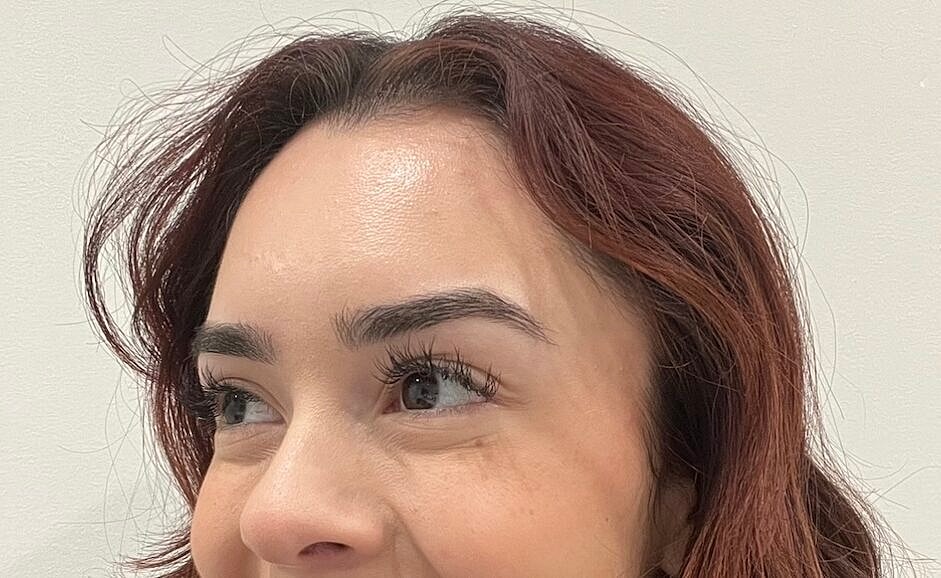 Toxin Treatments Before & After
