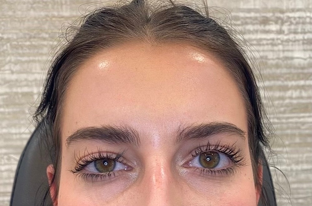 Toxin Treatments Before & After