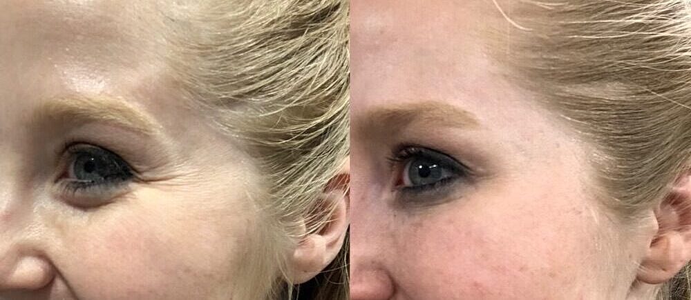 Toxin Treatments Before & After