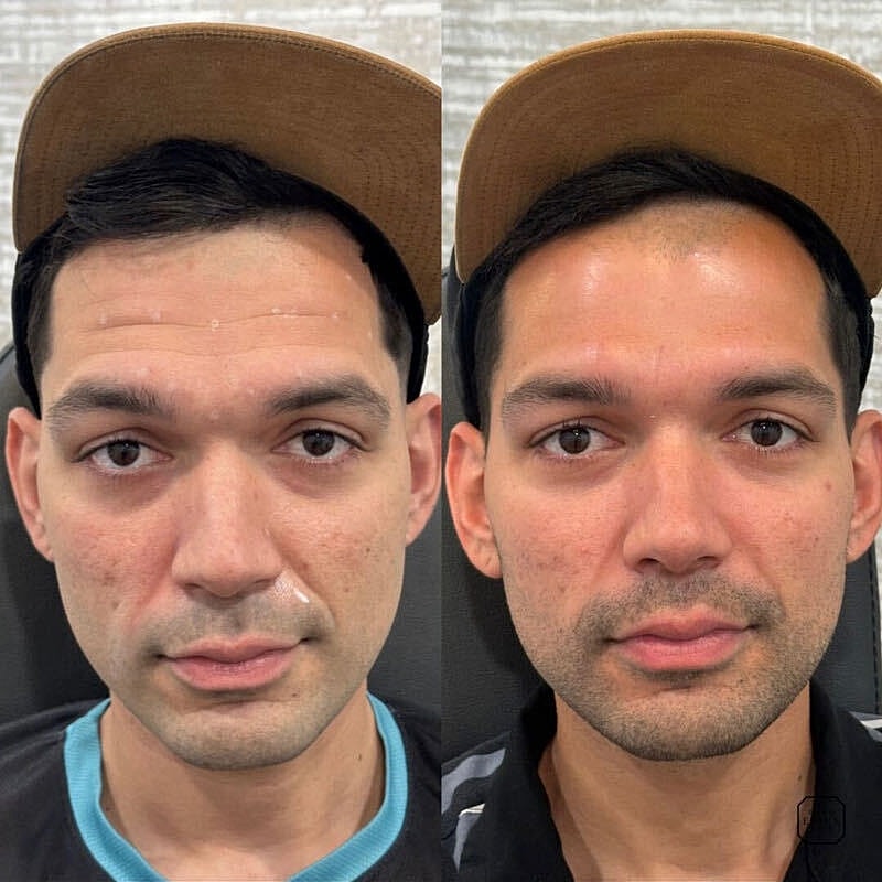 Toxin Treatments Before & After