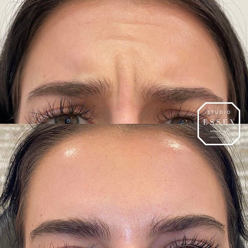 Toxin Treatments Before & After