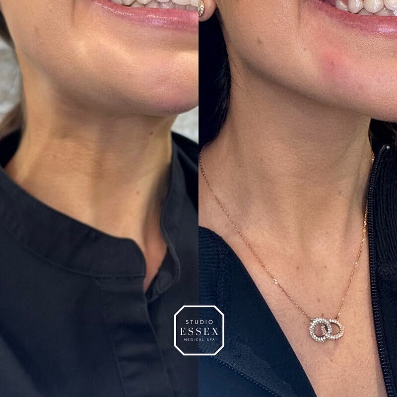 Toxin Treatments Before & After
