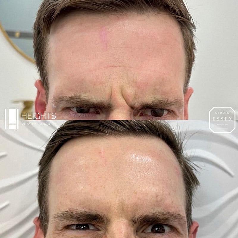 Toxin Treatments Before & After