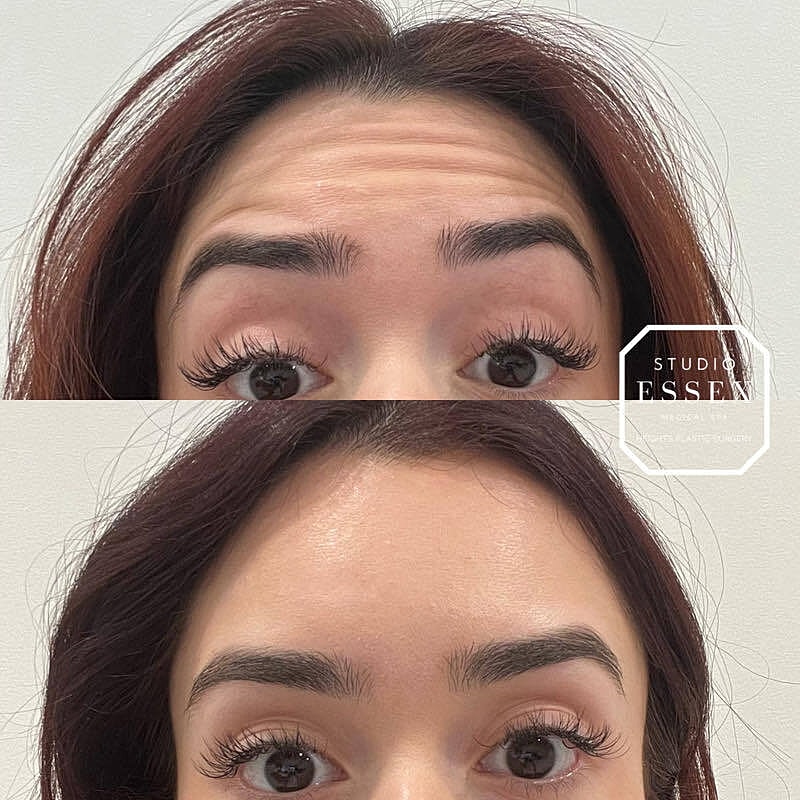 Toxin Treatments Before & After