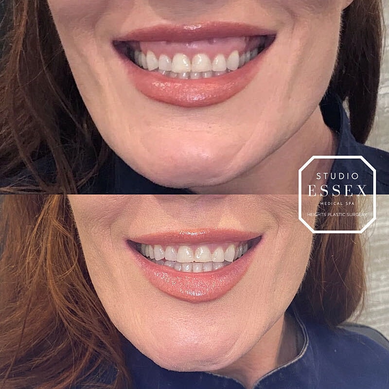 Toxin Treatments Before & After