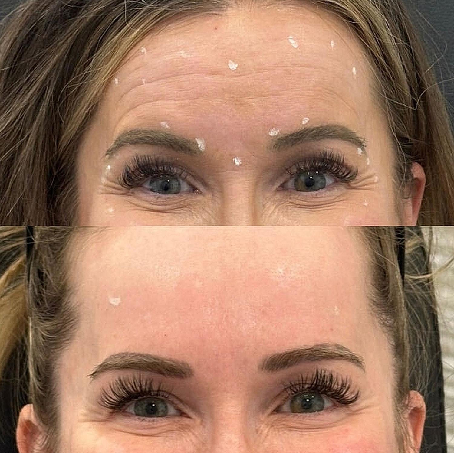 Toxin Treatments Before & After