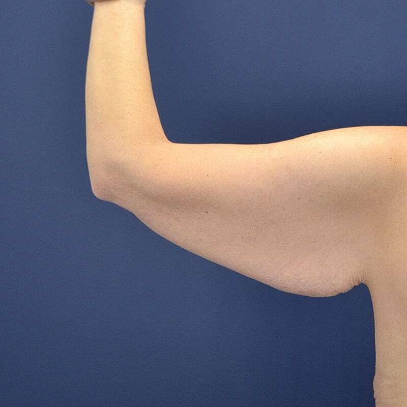 Arm Lift Before & After