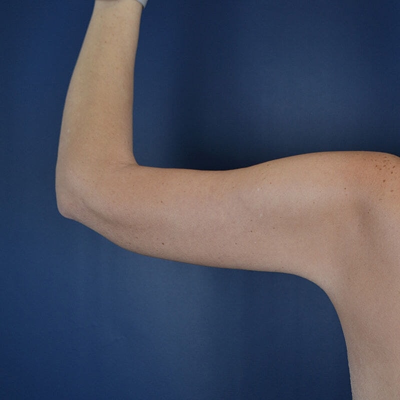 Arm Lift Before & After