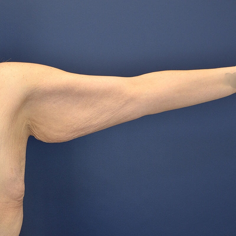 Arm Lift Before & After