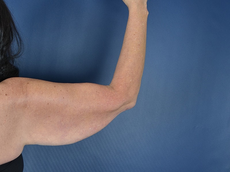 Arm Lift Before & After